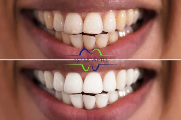 Aspire White customer before and after York results.