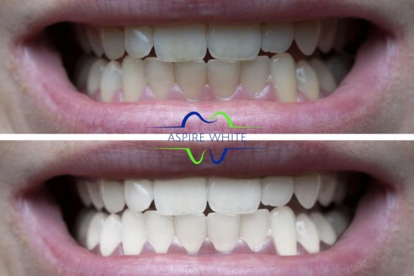 1 hour laser teeth whitening before and after results York
