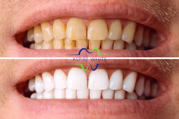 Get noticeable whiter smile in just one hour! Book your teeth whitening treatment York today!