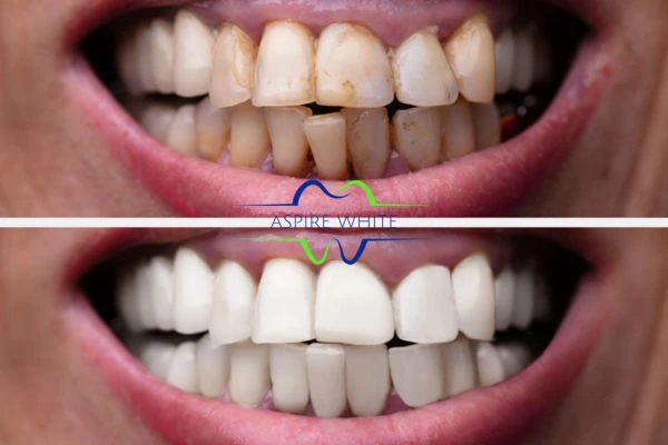 Before and after results of laser teeth whitening York Book in online today!