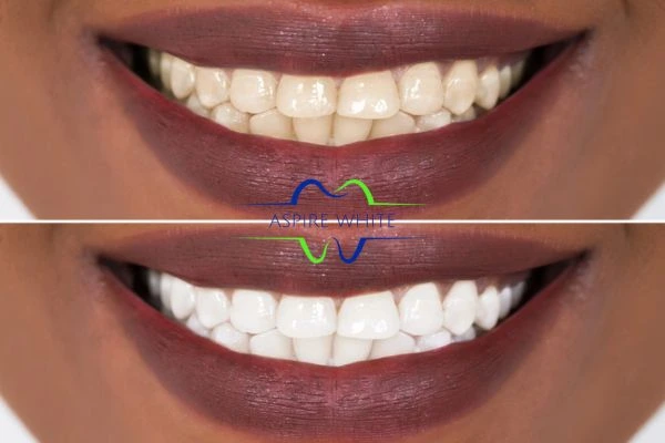 Side-by-side comparison showing before and after results of a cosmetic treatment York