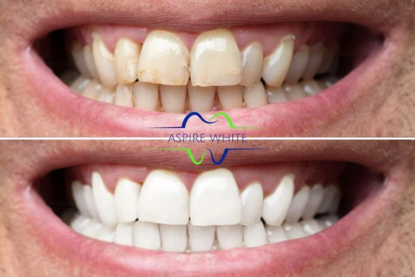 Achieve a radiant smile with professional laser teeth whitening York
